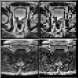 Prostate MRI super-resolution