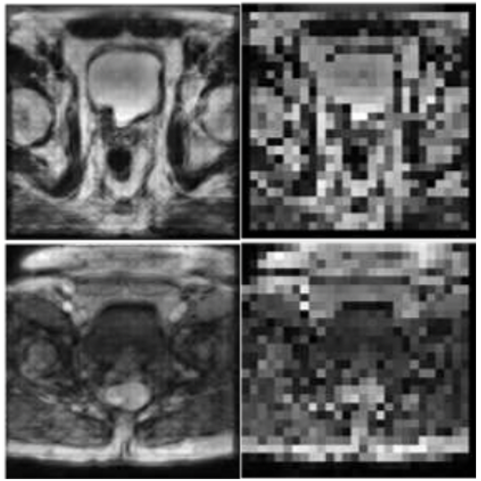 Prostate MRI Super-Resolution