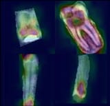 Tooth extraction and caries detection
